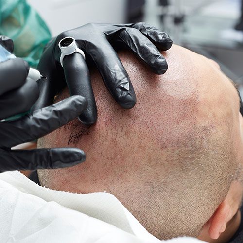 Scalp Effective Hair Loss Solution with Scalp Micropigmentation Dubai